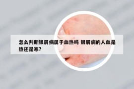 怎么判斷銀屑病屬于血熱嗎 銀屑病的人血是熱還是寒?