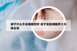 南寧什么牛皮癬醫(yī)院好 南寧皮膚病醫(yī)院十大排名榜