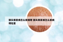 額頭銀屑病怎么做病理 額頭銀屑病怎么做病理檢查