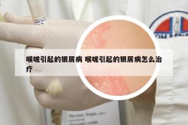 喉嚨引起的銀屑病 喉嚨引起的銀屑病怎么治療