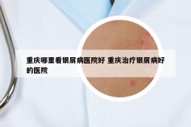 重慶哪里看銀屑病醫(yī)院好 重慶治療銀屑病好的醫(yī)院