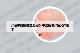 產(chǎn)后牛皮癬爆發(fā)怎么辦 牛皮癬生產(chǎn)后又嚴(yán)重了