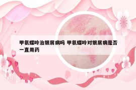 甲氨蝶呤治銀屑病嗎 甲氨蝶呤對銀屑病是否一直用藥