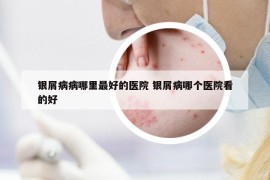 銀屑病病哪里最好的醫(yī)院 銀屑病哪個(gè)醫(yī)院看的好