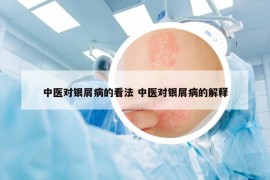 中醫(yī)對(duì)銀屑病的看法 中醫(yī)對(duì)銀屑病的解釋