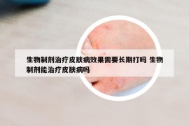 生物制劑治療皮膚病效果需要長期打嗎 生物制劑能治療皮膚病嗎