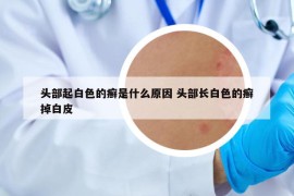 頭部起白色的癬是什么原因 頭部長白色的癬掉白皮