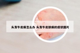 頭發(fā)牛皮癬怎么辦 頭發(fā)牛皮膚癬的癥狀圖片