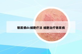 銀屑病dc細(xì)胞療法 細(xì)胞治療銀屑病