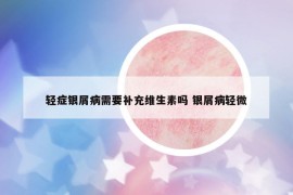 輕癥銀屑病需要補(bǔ)充維生素嗎 銀屑病輕微