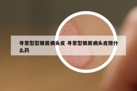 尋常型型銀屑病頭皮 尋常型銀屑病頭皮擦什么藥