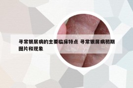 尋常銀屑病的主要臨床特點 尋常銀屑病初期圖片和現象