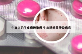 牛身上的牛皮癬傳染嗎 牛皮膚癬是傳染病嗎