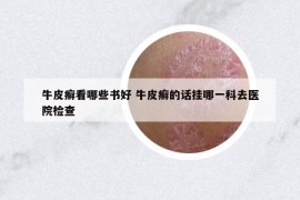 牛皮癬看哪些書(shū)好 牛皮癬的話掛哪一科去醫(yī)院檢查