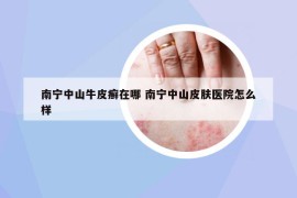 南寧中山牛皮癬在哪 南寧中山皮膚醫(yī)院怎么樣