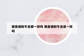 銀屑病和牛皮癖一樣嗎 銀屑病和牛皮屑一樣嗎