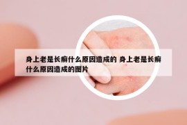 身上老是長癬什么原因造成的 身上老是長癬什么原因造成的圖片