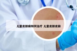 兒童皮膚癬如何治療 兒童皮膚皮蘚