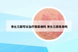 骨化三醇可以治療銀屑病嗎 骨化三醇有用嗎