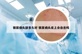 銀屑病頭部多久好 銀屑病頭皮上會(huì)自愈嗎