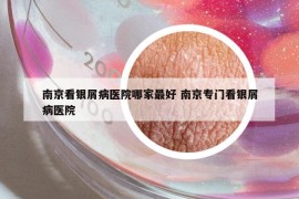 南京看銀屑病醫(yī)院哪家最好 南京專門看銀屑病醫(yī)院