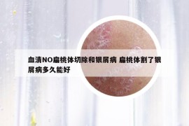血清NO扁桃體切除和銀屑病 扁桃體割了銀屑病多久能好