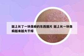 腿上長了一塊像癬的東西圖片 腿上長一塊像癬越來越大干癢