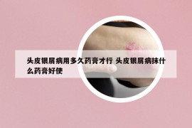 頭皮銀屑病用多久藥膏才行 頭皮銀屑病抹什么藥膏好使