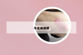 牛皮癬跟脾