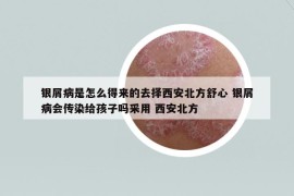 銀屑病是怎么得來的去擇西安北方舒心 銀屑病會傳染給孩子嗎采用 西安北方