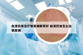 血清抗體治療銀屑病那家好 血清抗體怎么治銀屑病