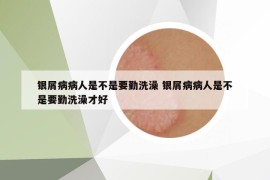 銀屑病病人是不是要勤洗澡 銀屑病病人是不是要勤洗澡才好