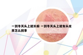 一到冬天頭上就長癬 一到冬天頭上就有頭皮屑怎么回事