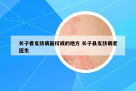 長(zhǎng)子看皮膚病最權(quán)威的地方 長(zhǎng)子縣皮膚病老醫(yī)生