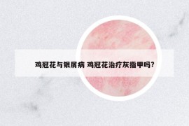 雞冠花與銀屑病 雞冠花治療灰指甲嗎?