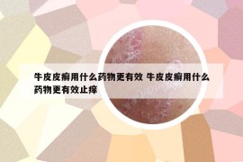 牛皮皮癬用什么藥物更有效 牛皮皮癬用什么藥物更有效止癢