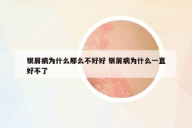 銀屑病為什么那么不好好 銀屑病為什么一直好不了
