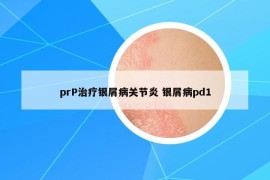 prP治療銀屑病關(guān)節(jié)炎 銀屑病pd1