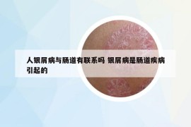 人銀屑病與腸道有聯(lián)系嗎 銀屑病是腸道疾病引起的