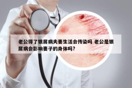 老公得了銀屑病夫妻生活會(huì)傳染嗎 老公是銀屑病會(huì)影響妻子的身體嗎?