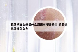 銀屑病身上癢是什么原因有哪些檢查 銀屑病患處癢怎么辦