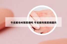 牛皮廨也叫銀屑病嗎 牛皮廨和銀屑癬圖片
