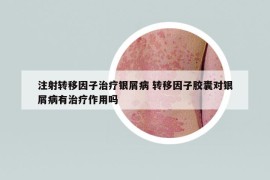 注射轉(zhuǎn)移因子治療銀屑病 轉(zhuǎn)移因子膠囊對銀屑病有治療作用嗎