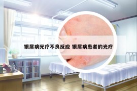 銀屑病光療不良反應(yīng) 銀屑病患者的光療