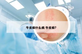 牛皮癬什么病 牛皮癬?