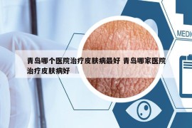 青島哪個(gè)醫(yī)院治療皮膚病最好 青島哪家醫(yī)院治療皮膚病好