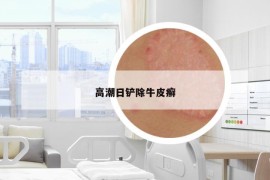 高潮日鏟除牛皮癬
