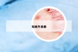 松糕牛皮癬