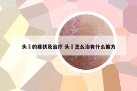 頭廯的癥狀及治療 頭廯怎么治有什么偏方