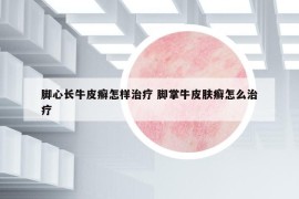 腳心長牛皮癬怎樣治療 腳掌牛皮膚癬怎么治療